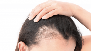 Read more about the article Hair Loss Treatment: रोज 1 चीज करके बंद हो जाएगा बालों का झड़ना