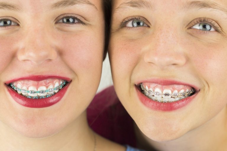 What Your Braces Colors Say About Your Personality?