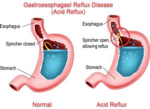 Read more about the article Symptoms of Gastroesophageal Reflux Disease (GERD)