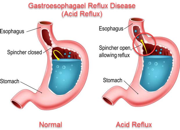 You are currently viewing Symptoms of Gastroesophageal Reflux Disease (GERD)