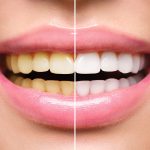Using Crest Whitestrips To Obtain Whiter Teeth