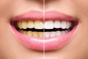 Read more about the article Using Crest Whitestrips To Obtain Whiter Teeth