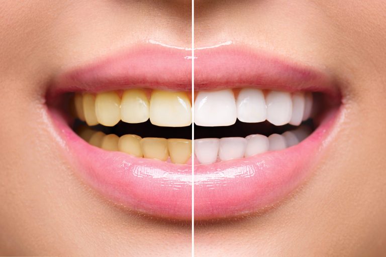 Using Crest Whitestrips To Obtain Whiter Teeth