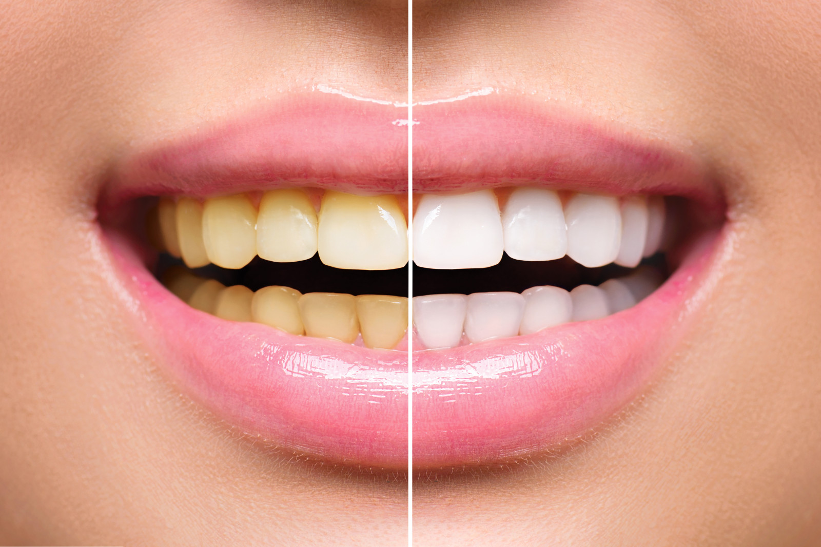 You are currently viewing Using Crest Whitestrips To Obtain Whiter Teeth