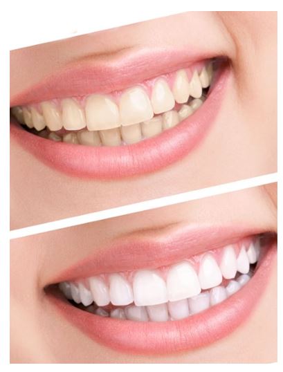 You are currently viewing Easier to keep teeth shining and healthier
